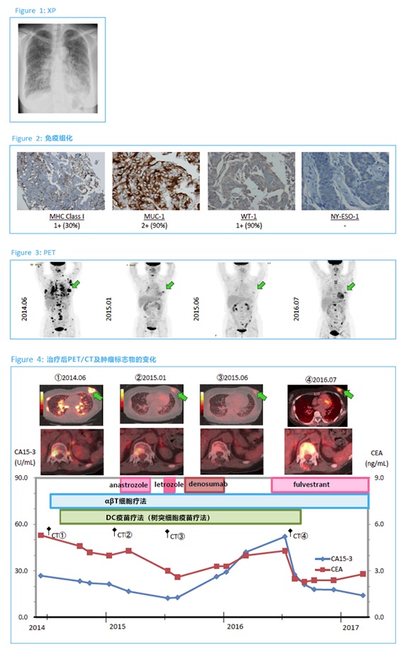 免疫細胞治療(αβT細胞療法+樹突細胞疫苗療法)治療乳腺癌奏效案例