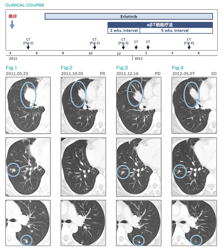 厄洛替尼耐藥后,免疫細胞治療(αβT細胞療法)治療后維持穩定狀態的肺癌(IV期)案例