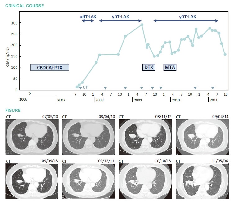 αβT細胞治療抑制腫瘤進展,γδT細胞治療維持長期穩(wěn)定的肺腺癌案例